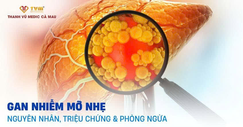 GAN NHIỄM MỠ NHẸ LÀ GÌ? TRIỆU CHỨNG VÀ PHÒNG NGỪA